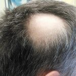 تساقط الشعر