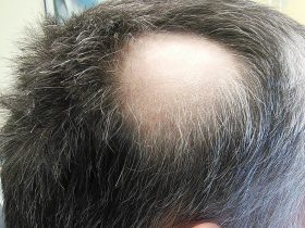 تساقط الشعر