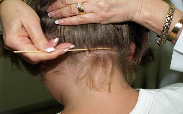 وصفات طبيعية للتخلص والوقاية من حشرات الشعر خاصة فى وقت المدارس !