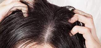 علاج-قشرة-الشعر-بطرق-طبيعية