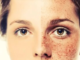 طرق-طبيعية-للتخلص-من-النمش