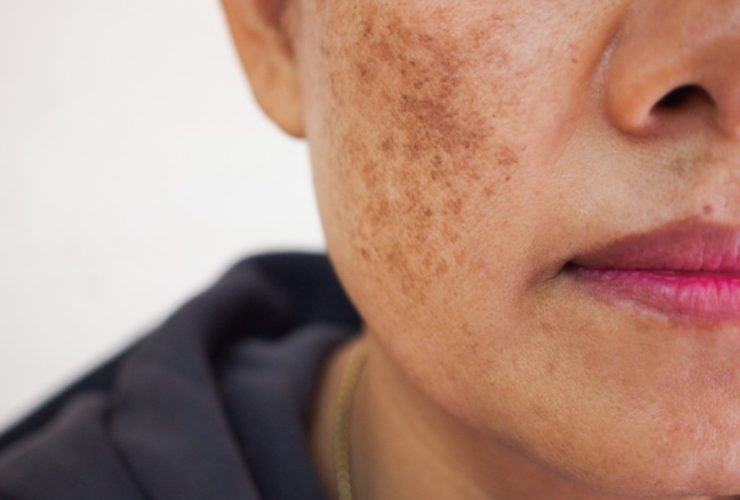 اسباب-الكلف-وكيفية-علاجه