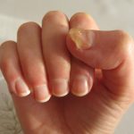 اعراض-فطريات-الأظافر-وطرق علاجها-والوقاية منها