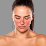 الذئبة الحمراء- كل المعلومات عنه-وكيفية علاجه