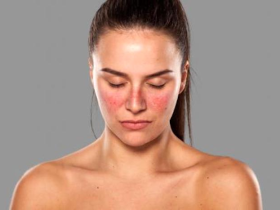 الذئبة الحمراء- كل المعلومات عنه-وكيفية علاجه