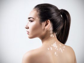 البهاق-واسبابه-وهل-له-علاج