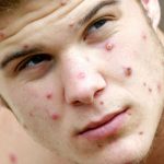 جدري-القرود-أعراضه-الوقاية-منه