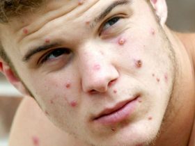 جدري-القرود-أعراضه-الوقاية-منه