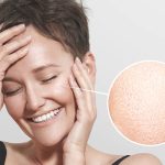 علاج-المسام-الواسعة