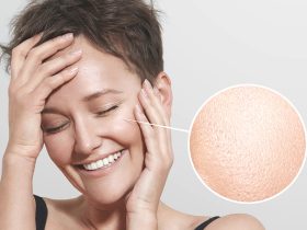 علاج-المسام-الواسعة