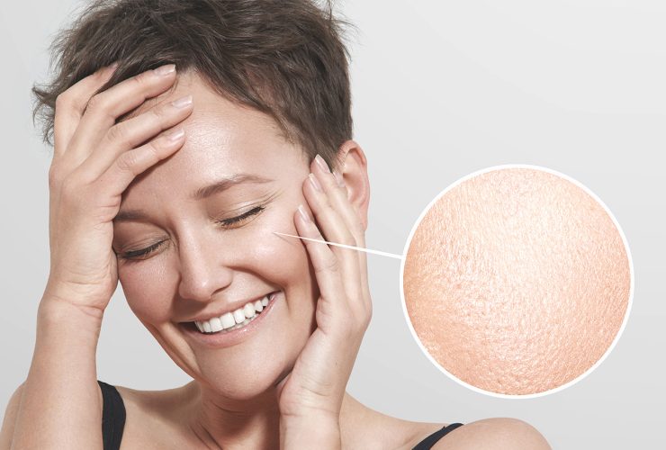 علاج-المسام-الواسعة